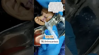 TMJ Arthrocentesis For TMJ Pain Relief Dr Parit Ladani 