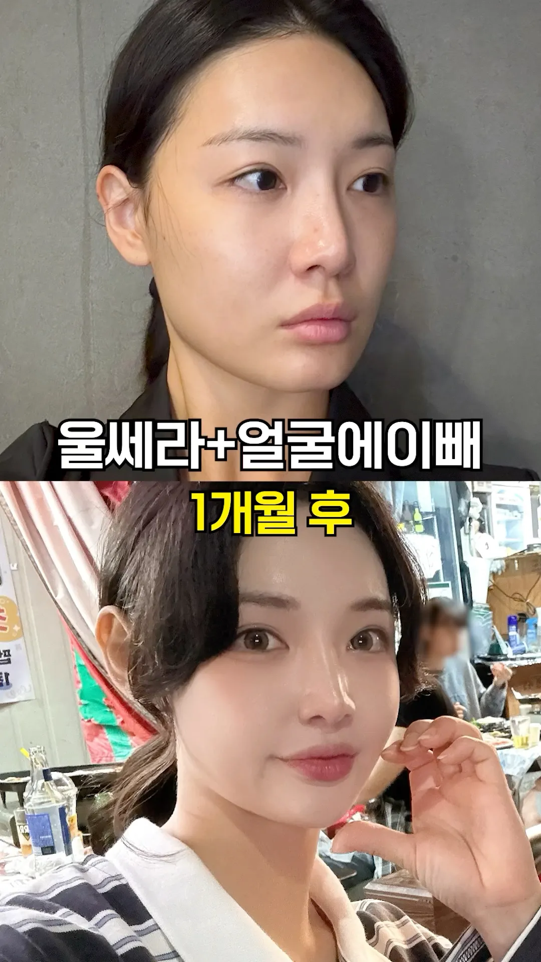 10초 안에 울쎄라 효과 체험하기☑️