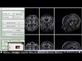 DARTEL VBM Lyon presentation 20170505