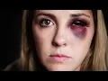 How to treat your BLACK EYE at home (... and when to see a doctor)