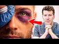 Lagu How to treat your BLACK EYE at home (... and when to see a doctor)