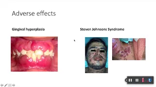 Anticonvulsants