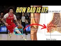 Expert Explains Lonzo Ball Injury knee contusion timeline scenarios