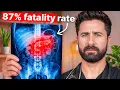 7 Warning Signs of Pancreatic Cancer That Appear Months Before Diagnosis Doctor Explains