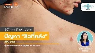 ทำไมการใช้ยาคุมกำเนิดถึงอาจช่วยรักษาสิวที่หลังได้