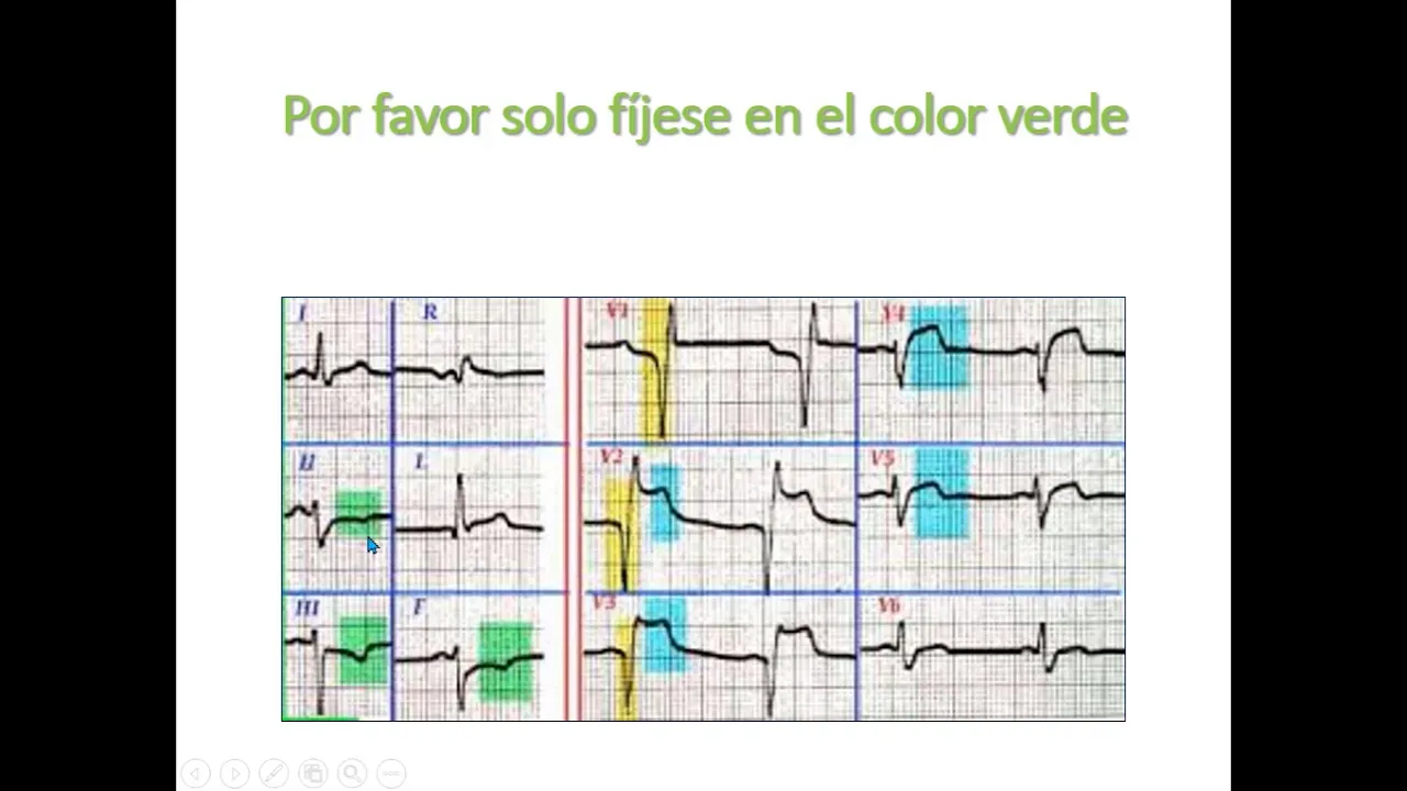 Electrocardiograma parte 5 - infarto básico