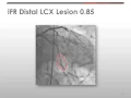 Download Lagu iFR® Modality (instant wave-Free Ratio™) For Tandem Lesion Assessment