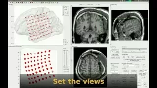 iElectrodes - Localising intracranial grid electrodes tutorial