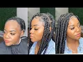 You DON T need a hairline to get box braids Alopecia approved detailed