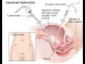 Laparoscopy total hysterectomy CPT code - simplify medical coding