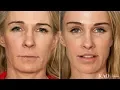 Facelift Before After - Ponytail Lift