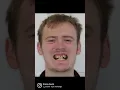 Before and after braces with brace book