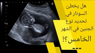 هل السونار يخطئ في تحديد نوع الجنين في الشهر الخامس   لماذا يخطئ السونار في تحديد نوع الجنين دندنها