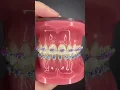 Different Types of Orthodontic Ties you can get at your Orthodontist Part 2