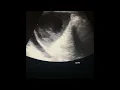 Case 230 Splenic Abscess