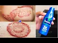 Ringworm Treatment At Home How to Get Rid of Ringworm With Garlic Fungal Infection Treatment