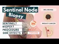 Sentinel Lymph Node Biopsy Procedure Side-effects Visual Explanation