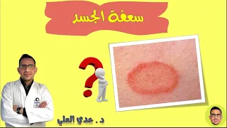 علاج سعفة الجسد فطريات الجلد علاج التينيا 