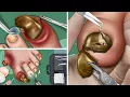Download Lagu ASMR Best treatment for toe swelling,ingrown nails, perennial toenail removal, deep clean treatment