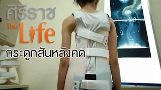 กระดูกสันหลังคดเป็นอย่างไรบ้าง