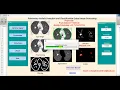Lung Nodule Detection Using Image Processing Matlab Project with Source Code