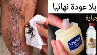 كيفية استخدام الفازلين والخل‼️ للتخلص من شعر الوجه والجسم والعانة بدون ألم وبلا عودة نهائياوصفات