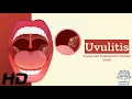 Uvulitis Explained What s Causing Your Swollen Uvula