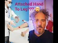 Download Lagu Doctors Attached His Hand to His Leg!