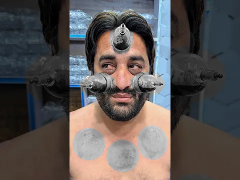Hijama For Face Acne, Pimples, Acne Marks & Freckles | Natural Skin Wellness | Dr Usman Faiz