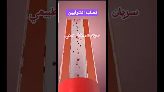 تصلب الشرايين  تصلب الشرايين