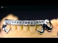 Custom Kim K Style Grillz with Heart Open Face Design Dayyani Jewelers - Houston s Best