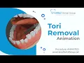 Tori Removal A Guide by HARAZ Dental Group