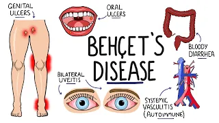 Download Behcets Disease - Signs and Symptoms (with Triad) | Pathophysiology | Criteria \u0026 Treatment MP3