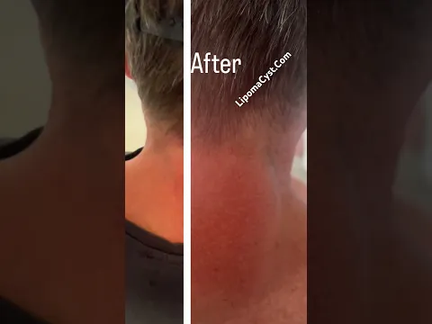 Before and after #cystremoval #drkhaledsadek LIPOMACYST.com