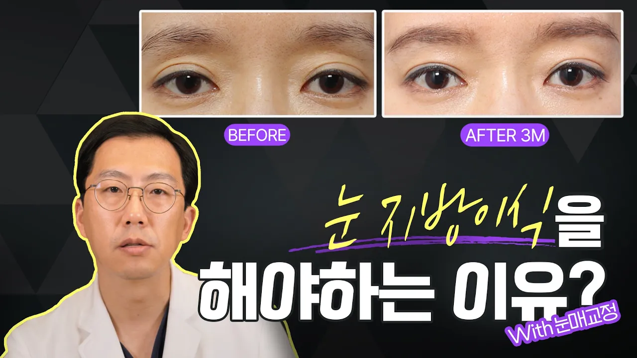눈두덩이 지방이식이 필요한 케이스?😕 눈매교정과 같이 해야하는 이유는??#눈두덩이지방이식#그레이스성형외과 #닥터초이 #최문섭