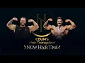 CBUM s Hair Transplant Now Hair Time