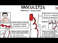 Vasculitis Overview - types and classification