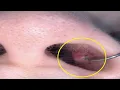 how to get rid of a piercing bump inside your nose permanently