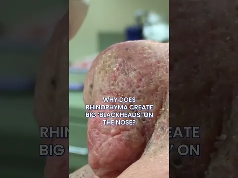 Big Blackheads On The Nose Can Be Caused By Rosacea?