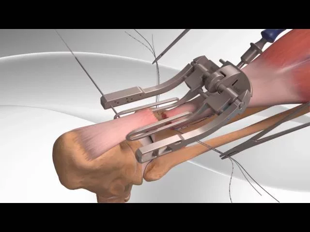 Achilles Tendon Rupture Repair with Arthrex® PARS System
