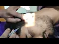 Download Lagu TMJ arthrocentesis By Dr Mostafij Rahman