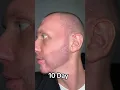 Download Lagu Beard Transplant Result | Beard Transplant Before and After 5000 Grafts Result 12 months timelapse