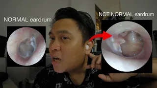Operasyon sa tenga + how much is the cost + what to expect
