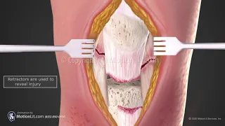 Patella Tendon Repair
