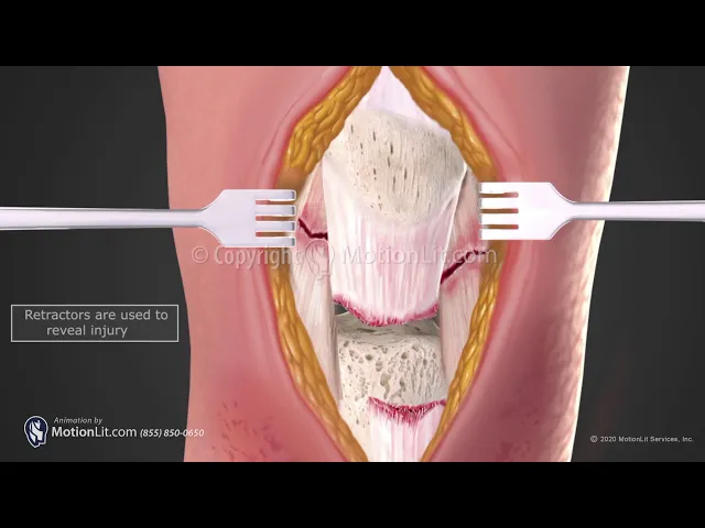 Patella Tendon Repair