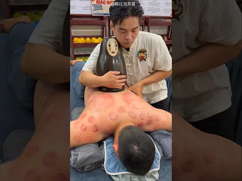 ¡Este Hombre Se Quedó Dormido Durante La Terapia De Ventosas! 😱🙆🏻♂️