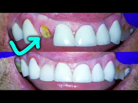 Download MP3 Broken Front Tooth Repair By A Dentist! How to Fix a Crown Fractured at Gumline!