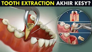 The Complete Tooth Extraction Procedure Explained in 3D