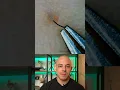 Doctor reacts to massive ingrown hair removal
