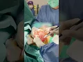 Download Lagu Plastic surgeon G. Samulenas removing breast implants for a patient with capsular contracture.